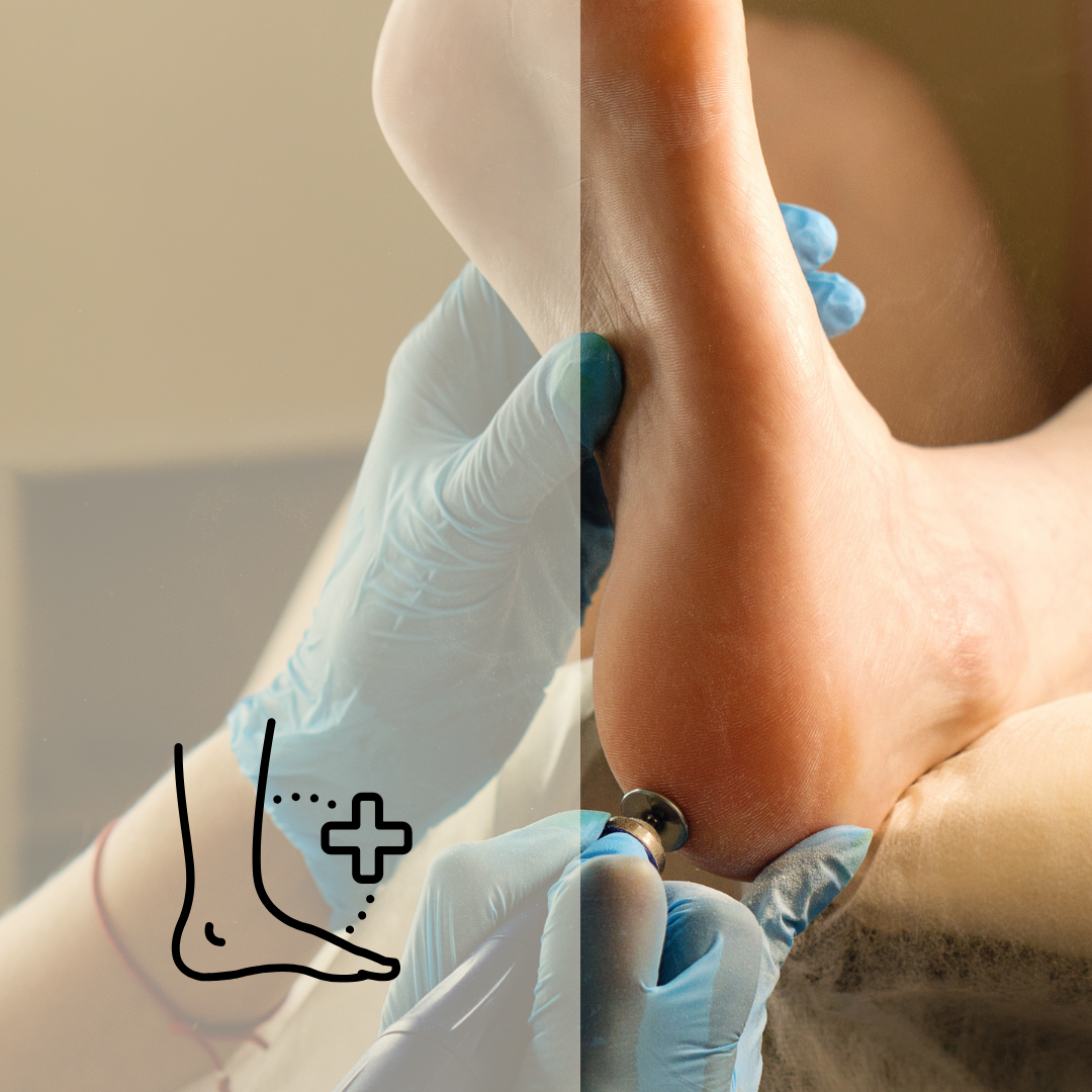 Advanced Foot Peel