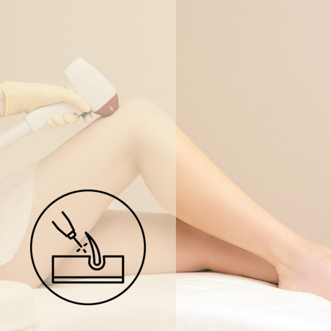 ICE™ Laser Hair Removal